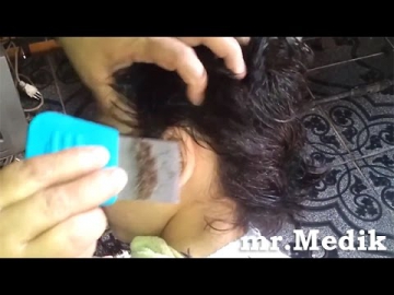 Невероятное количество вшей на голове девочки || Head Lice