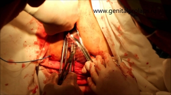 Операция по поводу опущения задней стенки влагалища (ректоцеле)