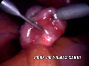 Kapalı Tüplerin Laparoskopik Olarak Açılması (laparoskopik salpingoneostomi ve salpingoskopi)