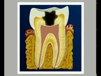 Лечение зубов. Строение зуба, кариес и его осложненные формы