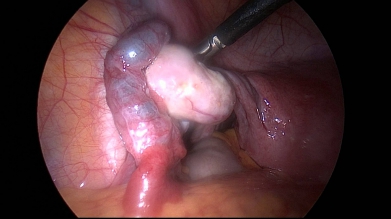 Fibroid Uterus, Retroverted uterus, Ventrosuspension, Infertility, Painful Sex, Painful period 1