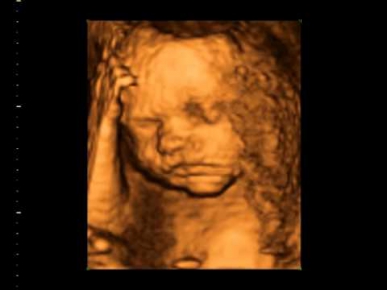 3D УЗИ: Младенец в утробе матери