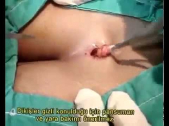 Kıl Dönmesi Ameliyatı Görüntüleri Video izle Kıl Dönmesi Ameliyatı Nasıl Yapılır youtube original