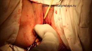 Операция при опущении задней стенки влагалища (ректоцеле)